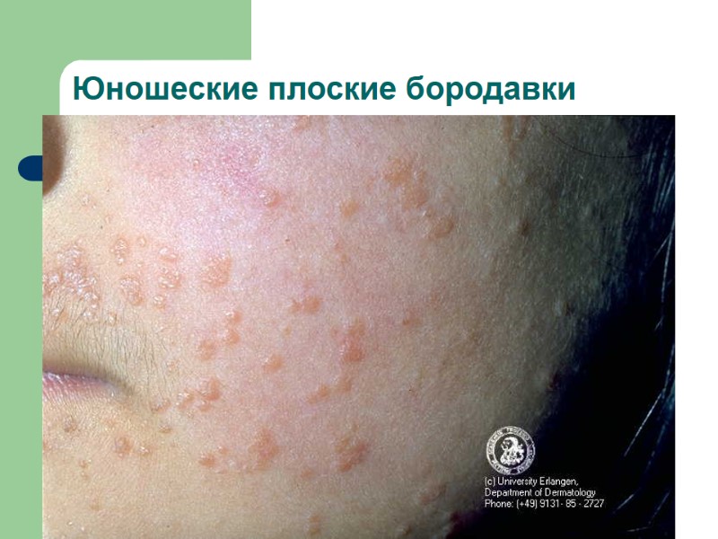 Юношеские плоские бородавки